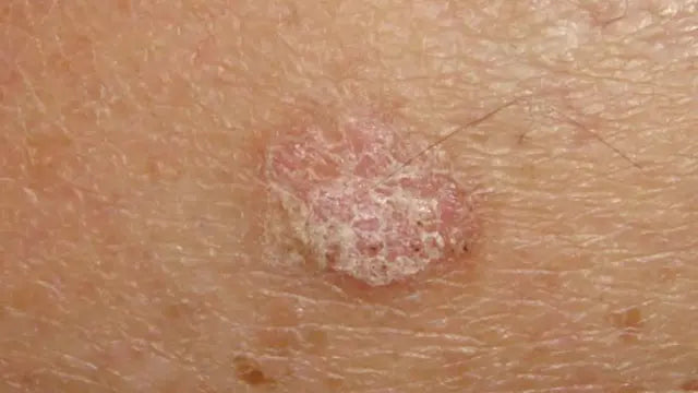 Medical Grade Kanuka Honey: A Sweet Solution for Actinic Keratosis?