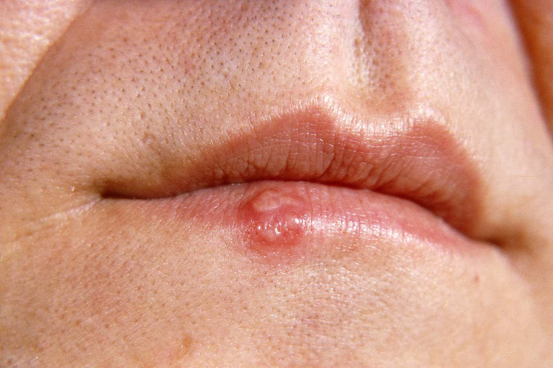 The Sweet Relief: How Medical Honey Heals Cold Sores Faster