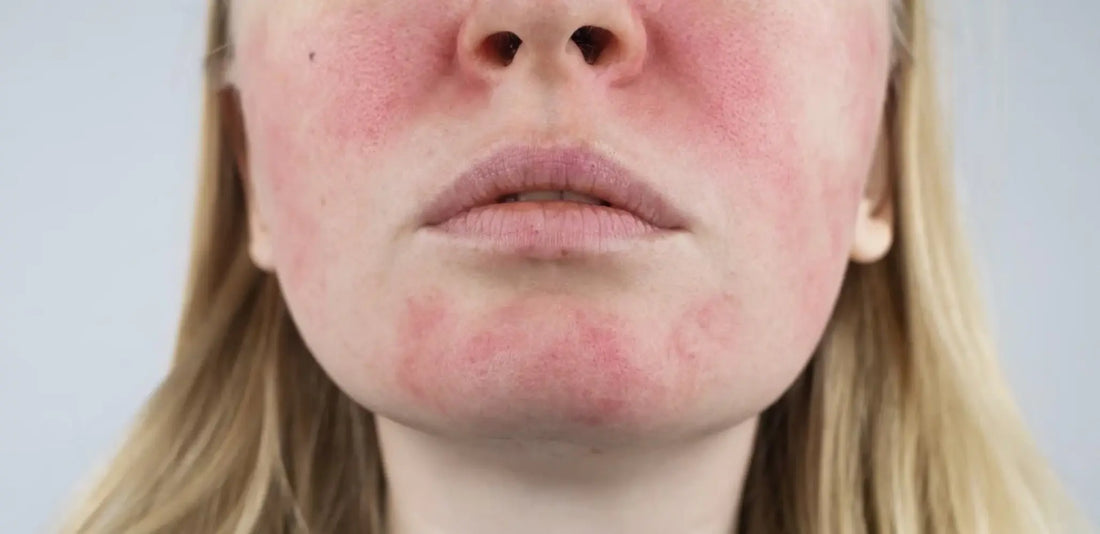 Understanding Rosacea: Natural Care for Sensitive Skin