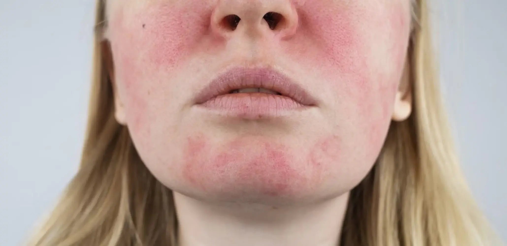 Understanding Rosacea: Natural Care for Sensitive Skin